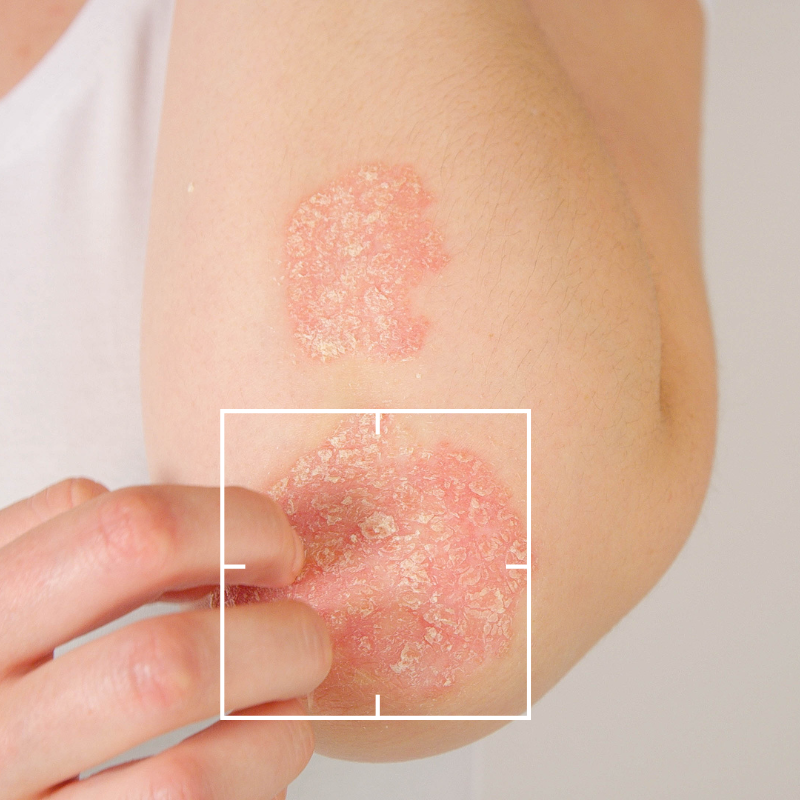Tratamiento de Psoriasis