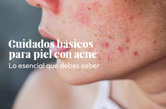 Cuidados básicos para piel con acné: Lo esencial que debes saber