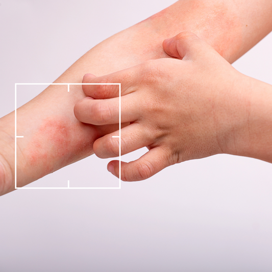 Tratamiento de Dermatitis