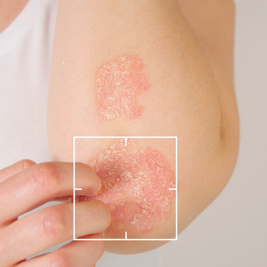 Tratamiento de Psoriasis