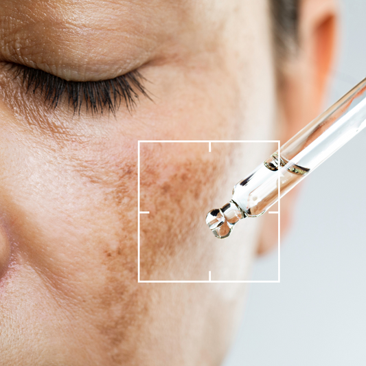 Manchas Rostro y Melasma